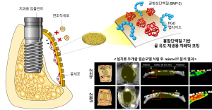 포스텍-경북대-고려대 안암병원 공동연구팀, 골 재생 극대화 임플란트용 차폐막 코팅 개발